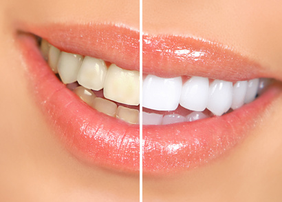 Blanchiment dentaire : à quels résultats puis-je m'attendre ?